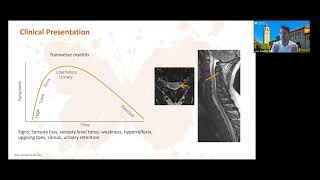 Diagnosis of Multiple Sclerosis [upl. by Rennug]