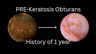 Pre Keratosis Obturans A Condition that Warrants the Cleaning of Ear [upl. by Reace49]