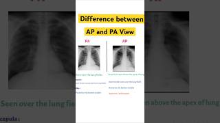 DIFFERENCE BETWEEN AP AND PA VIEW  X RAY REPORTING How to report CXR  MBBS  aiims medicalexam [upl. by Cassady]