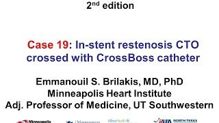 Case 19 Manual of CTO Interventions  CrossBoss for instent CTO [upl. by Auot]