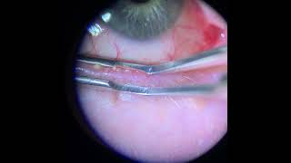 Meibomian Gland Expression Upper and Lower Lid [upl. by Esbenshade]