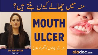 Mouth Ulcers Treatment Munh Ke Chalo Ka Ilaj Mouth Sores Home Remedy Muh Ke Chale Kaise Thek Kare [upl. by Aranaj]