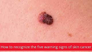 How to recognize the five warning signs of skin cancer │News podcasts [upl. by Guillaume173]