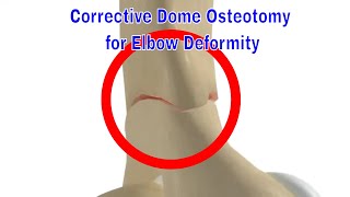 Corrective Dome Osteotomy for Cubitus Varus and Valgus Deformity [upl. by Yzus]