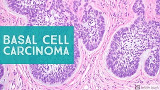 Basal Cell Carcinoma BCC 101  Dermpath Basics Explained by a Dermatopathologist [upl. by Seebeck]