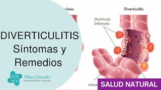 Diverticulitis Síntomas y Tratamiento Natural ¡Descubre Cómo Aliviar los Malestares Digestivos [upl. by Powers]