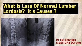 What Is Loss of Normal Lumbar Lordosis Its Causes [upl. by Ardnos788]