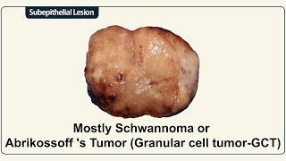 Mostly Schwannoma or Abrikossoff s Tumor Granular cell tumorGCT [upl. by Johns556]