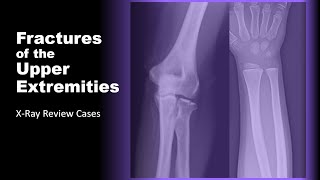 Fractures of the Upper Extremities on XRay radiology xray doctor [upl. by Chung]