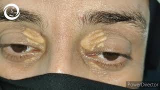 Xanthelasma palpebrarum [upl. by Akinyt]