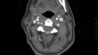 Vertebral artery injury [upl. by Eseilana]