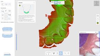 Os Primeiros Passos com o Scanner Intraoral Medit i500 [upl. by Rolf406]