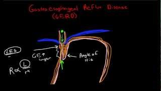 Pathophysiology of Gastroesophageal Reflux Disease GERD [upl. by Initof]