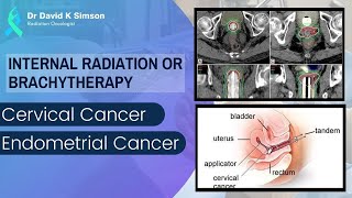 Brachytherapy or Internal Radiation of Cervical amp Endometrial Cancer  Dr David K Simson [upl. by Harpole]