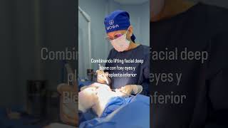 Lifting facial deep plane  Blefaroplastia y foxy eyes blefaroplastia foxyeyes liftingfacial [upl. by Ultun]