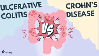 Inflammatory Bowel Disease Ulcerative Colitis vs Crohns Disease [upl. by Rudich]