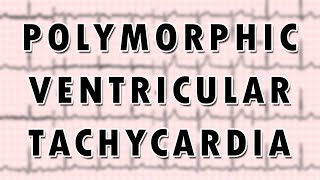 Ventricular Tachycardia [upl. by Olinad]