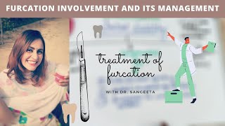 furcation involvement treatment easy explain [upl. by Elylrac]