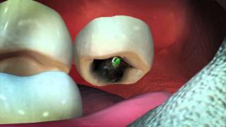 Dentist finds guava sprout growing in mans cavity [upl. by Alys]