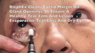 BlephEx Eyelid Treatment For Dry Eyes Blepharitis by Dr Burroughs in Colorado Springs [upl. by Oicnoel76]