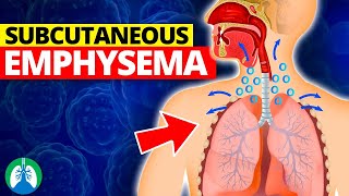 Subcutaneous Emphysema Medical Definition  Quick Explainer Video [upl. by Bergen496]