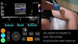 Ultrasound Tutorial DVT  Lower Limb Veins  Radiology Nation [upl. by Doretta775]