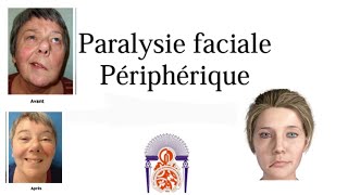 paralysie faciale périphérique  part 1 [upl. by Zeiger]