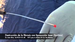 lipo laser fibrosis [upl. by Niarda]