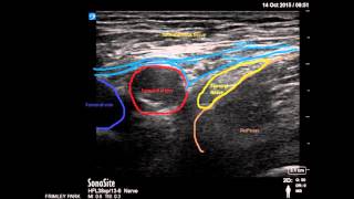 Ultrasound guided Femoral nerve block [upl. by Cordy29]