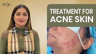 Treatment For Acne Skin  Treatment For Active Acne  Best Dermatologist and Skin Care Specialist [upl. by Ydnelg]