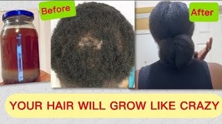 Your Hair will Grow 5X Faster  Get rid of Baldness amp Dandruff Quickly 😱 dont wash it out diy [upl. by Anitrak354]