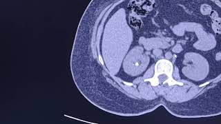 Renal ureteric stone hydronephrosis and renal swelling CT findings [upl. by Neetsirk848]