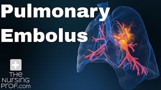 Pulmonary Embolus Nursing Care [upl. by Ahsirahc]