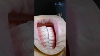 Occlusal Splint for a Bruxism Patient  Dr Rami Albahri [upl. by Nyledam]