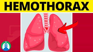 Hemothorax Medical Definition  Quick Explainer Video [upl. by Olodort67]