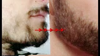 ➽ Turn Patchy beard to Thick beard in 7 days Natural Home Remedies [upl. by Leong877]