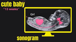 Normal fetal brain anatomy at 1113 weeks  2D scan [upl. by Fey]