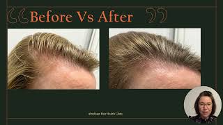 Low Vitamin D Hair Loss A Growing Concern [upl. by Spense126]