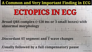 ECG Ectopics Explained  Learn about Ectopics APCs amp VPCs  Ventricular Trigeminy ECG [upl. by Jada]