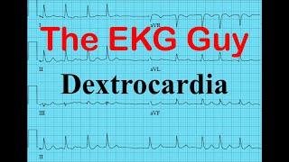 EKGECG  Dextrocardia  The EKG Guy  wwwEKGmd [upl. by Archibaldo]