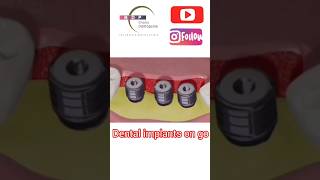 How are Dental Implants placed teeth dentist implants [upl. by Dj636]