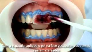 Whiteness HP Maxx  FGM l Dental Speed [upl. by Annoed]