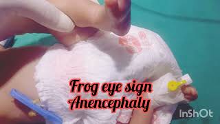 Frog eye sign in Anencephaly Incomplete skullUnderdeveloped brain [upl. by Ahsinirt428]