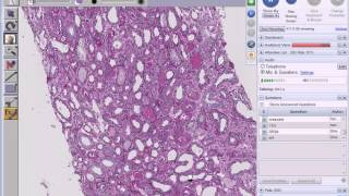 Medical School Pathology 2013 Season Session 20 Renal III [upl. by Ahsenev]