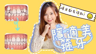 【隱適美Invisalign EP1 】隱形箍牙｜見牙醫諮詢過程大公開！超亂爆牙都有得救？ [upl. by Morey]