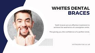 How Braces Work  London  Whites Dental [upl. by Browne]