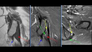 MRI Hip 12 [upl. by Eytak984]