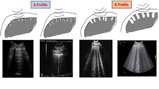 Lecture 4 Lung US in interstitial syndrome [upl. by Anamor]