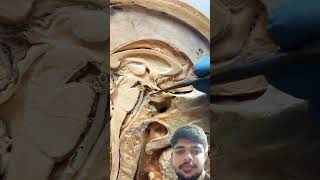 Real Human Pituitary Gland And Stalkmedicalanimation humananatomy pituitarytumor pituitary [upl. by Kinsley]