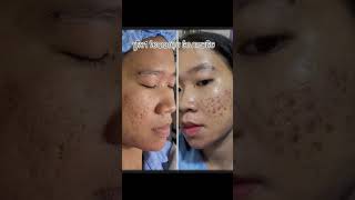 Treatment acne scars with TCA cross by Dr Theara [upl. by Esilenna]